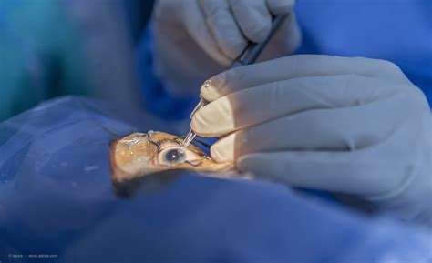 Presbyopia IOL 的图像结果