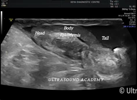 NORMAL SCROTAL ANATOMY – Case By Dr. Nitin Jadhav