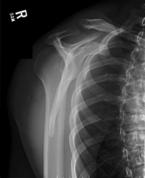Irreducible Traumatic Posterior Shoulder Dislocation - JETem