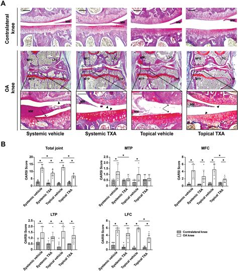 Tranexamic Acid Attenuates the Progression of Posttraumatic ...