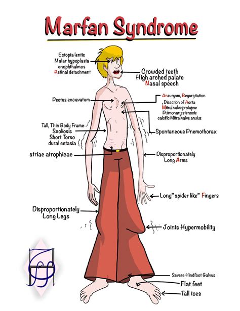 Marfan Syndrome - MEDizzy