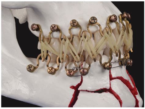 Matrix WaveTM System for Mandibulo-Maxillary Fixation—Just Another ...