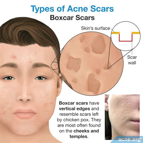 What Are Boxcar Scars at Theodore Kemp blog