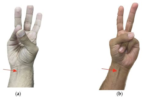 Anatomical Study of the Palmaris Longus Muscle and Its Clinical Importance