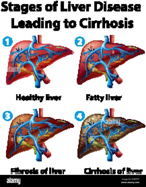 Stages of liver disease leading to Cirrhosis illustration Stock Vector Image & Art - Alamy