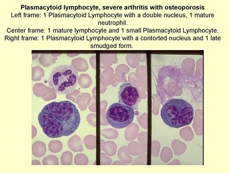Image result for Lymphocyte Precursor