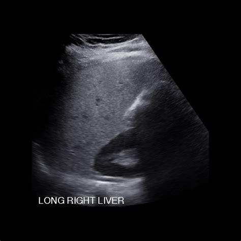 Pediatric Hepatic Steatosis | Pediatric Radiology Reference Article | Pediatric Imaging ...