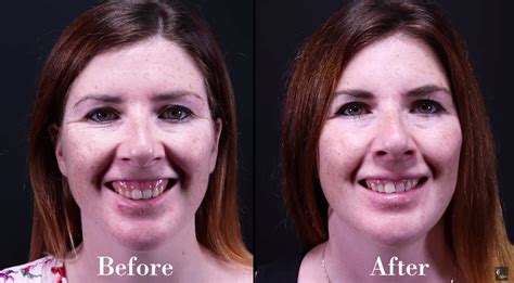 Gummy Smile Treatment | Victorian Cosmetic Institute