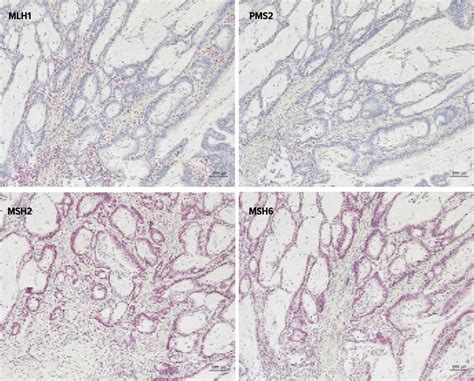 Le diagnostic de pathologie moléculaire dans le carcinome colorectal ...