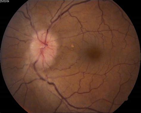 Optic Nerve Disease - Eye Specialist, Treatments, Types and Symptoms
