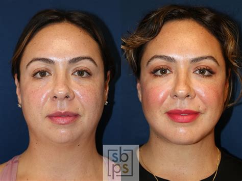 Chin Liposuction Before and After Pictures Case 631 | Los Angeles, Torrance & Long Beach, CA ...