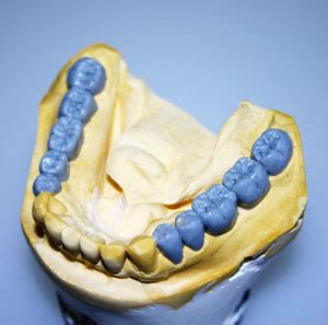 Full Mouth Dental Rehabilitation in Nagpur