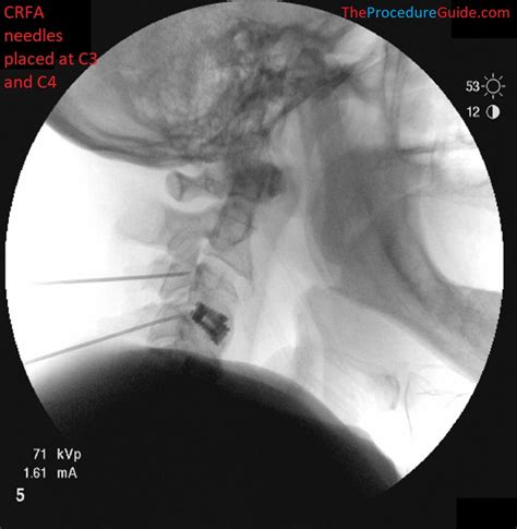 Image result for Shoulder Injection Fluoroscopy