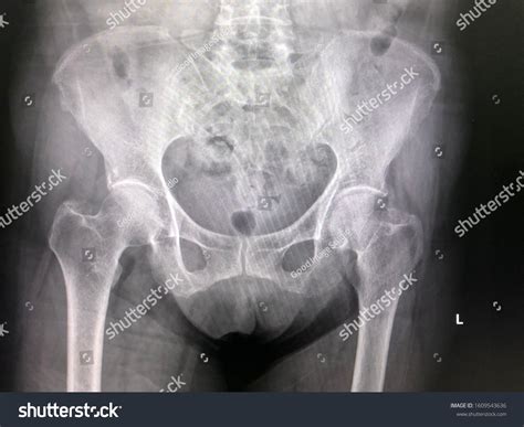 Hip X Ray