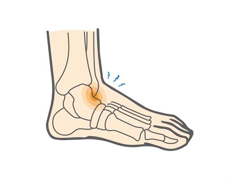 Tape Anterior Ankle Impingement at Frances Festa blog