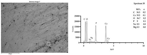 SEM-EDX Analysis of Metal Particles Deposition from Surgical Burs after ...