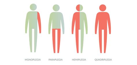 Paralysis 的图像结果