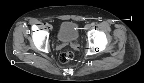 Pelvic Ct Anatomy