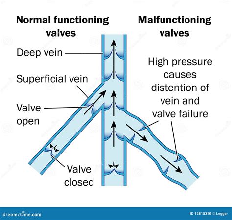 Normal and Malfunctioning Vein Valves Stock Vector - Illustration of ...