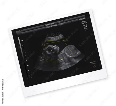 Ultrasound 的图像结果