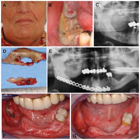 Pathologic Fractures in Bisphosphonate-Related Osteonecrosis of the Jaw ...