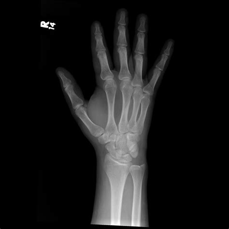 Wrist fracture - gulubroad