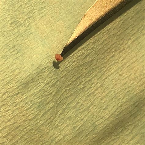 What Causes Calcium Deposits On Your Eyelids - Infoupdate.org