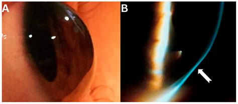 Pellucid Marginal Degeneration: A Comprehensive Review of ...
