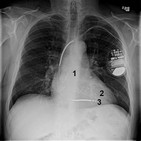 Image:Chest X-Ray of a Patient with a Biventricular (bi-V) Implantable Cardioverter ...