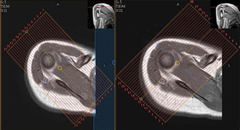 Mr Arthrogram Shoulder 的图像结果