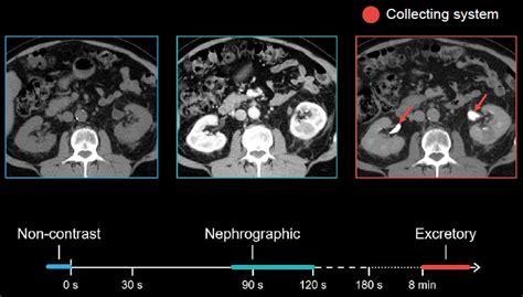 Image result for Cystogram Procedure for CT Scan