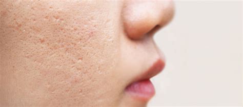 Try These Easy Ways To Remove Acne Scars – Re'equil