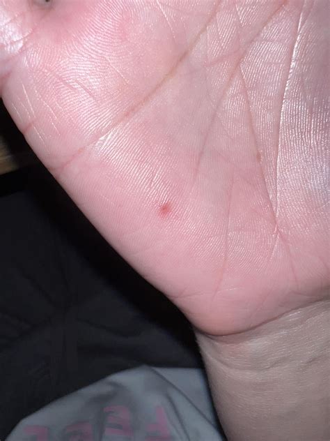 Small red bump on palm of hand : r/skin