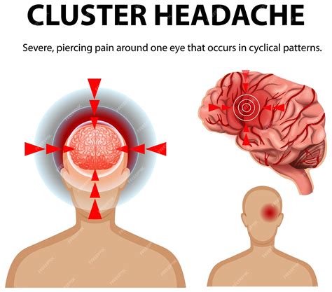 Cluster Headaches Symptoms