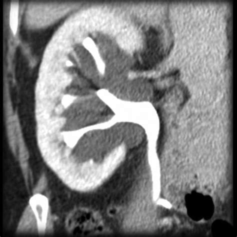 Kuvatulokset haulle parapelvic cyst kidney