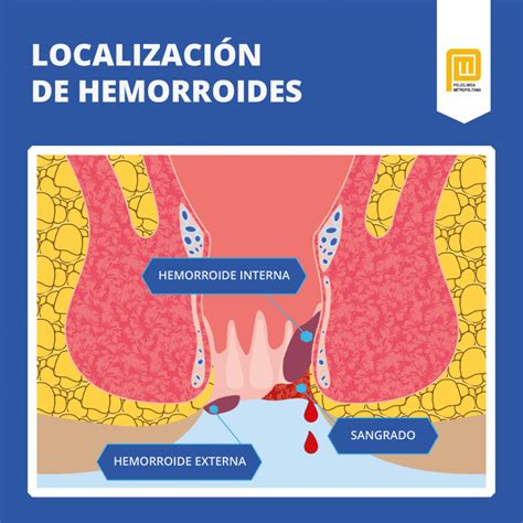 Hemorroides: ¿Qué son? ¿Por qué salen? ¿Cuáles son sus grados ...
