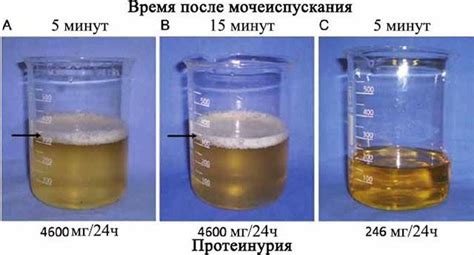Узнайте причины почему пенится моча у мужчин