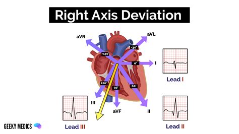 Understanding an ECG | ECG Interpretation | Geeky Medics
