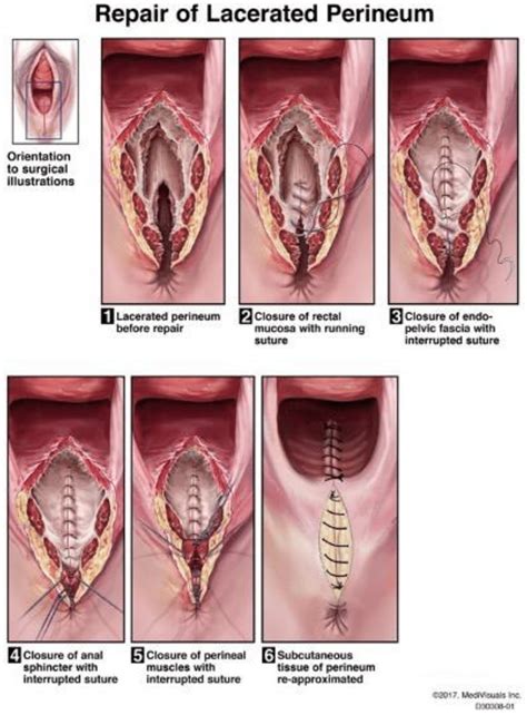 Transperineal perineoplasty with anal sphincteroplasty: cloacal reconstruction for 4th degree ...