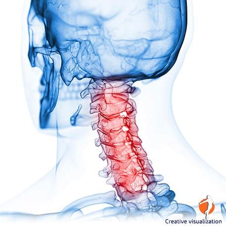 Neck Pain - Causes, Symptoms & Pain Relief - Iodex India