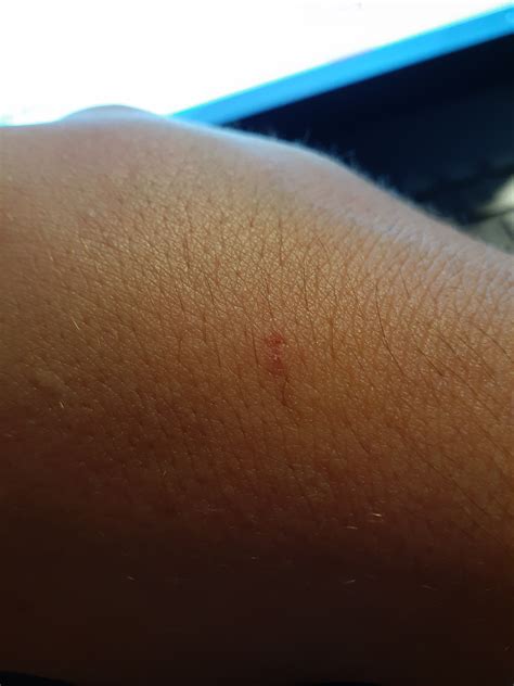 What Does A Bat Bite Look Like On A Person at Mason Mullan blog