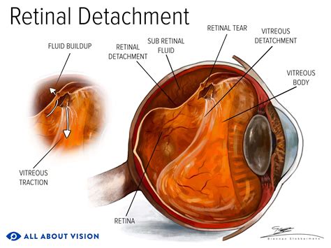 Retinal Detachment: Causes, Symptoms, Treatment & Surgery