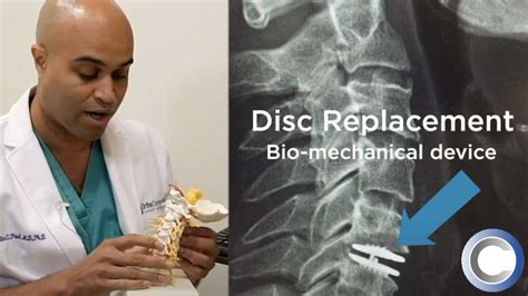 Image result for Disc Surgery