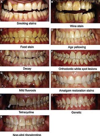 CLASSIFICATION OF TOOTH DISCOLORATION – Dentowesome