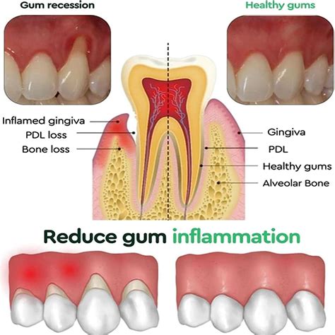 Healthy Gums Vs Unhealthy Gums