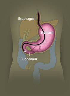 Image result for EDG Procedures