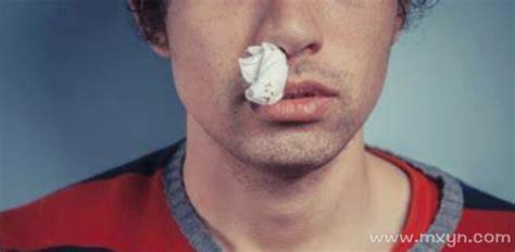 流鼻血原因, 流鼻血處理, 鼻咽癌症狀, 流鼻血鼻咽癌