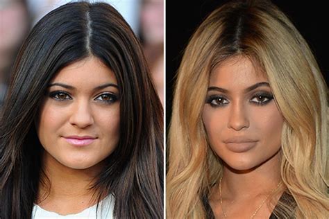 Bildergebnis für lip+fillers+for+celebrities