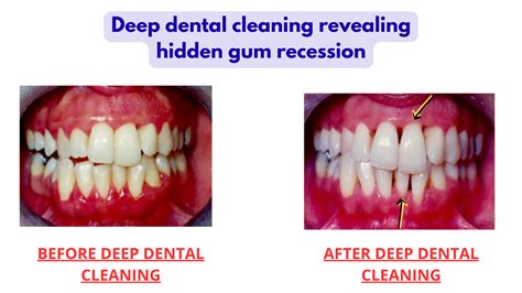 How to Heal and Shrink Gum Pockets Before It's Too Late