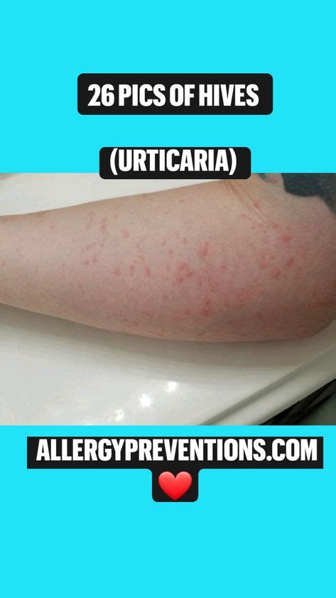 allergies hives